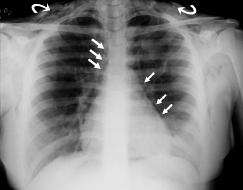 Radiografia de tórax em postero-anterior