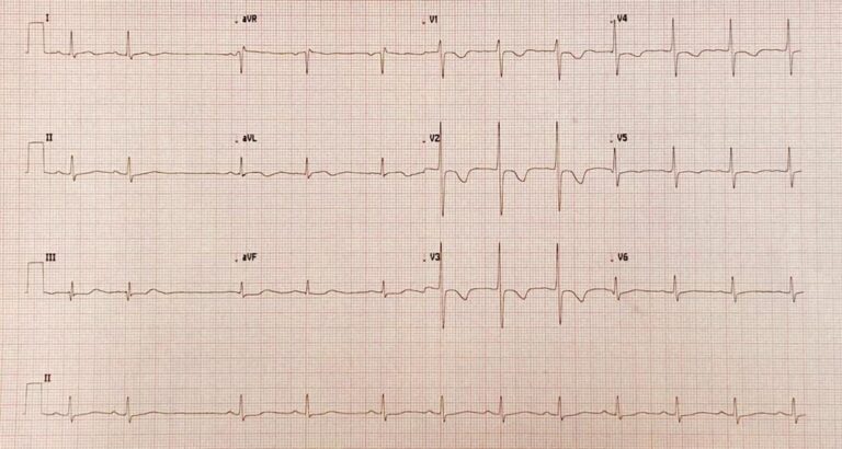 7-passos-para-interpretar-o-ecg, Eletrocardiograma, como interpretar eletro