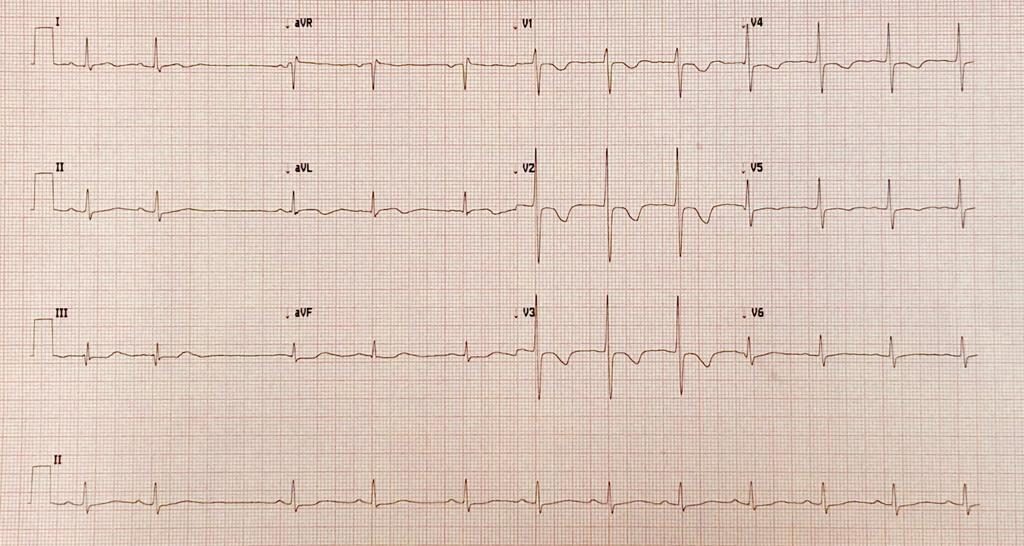 7-passos-para-interpretar-o-ecg, Eletrocardiograma, como interpretar eletro